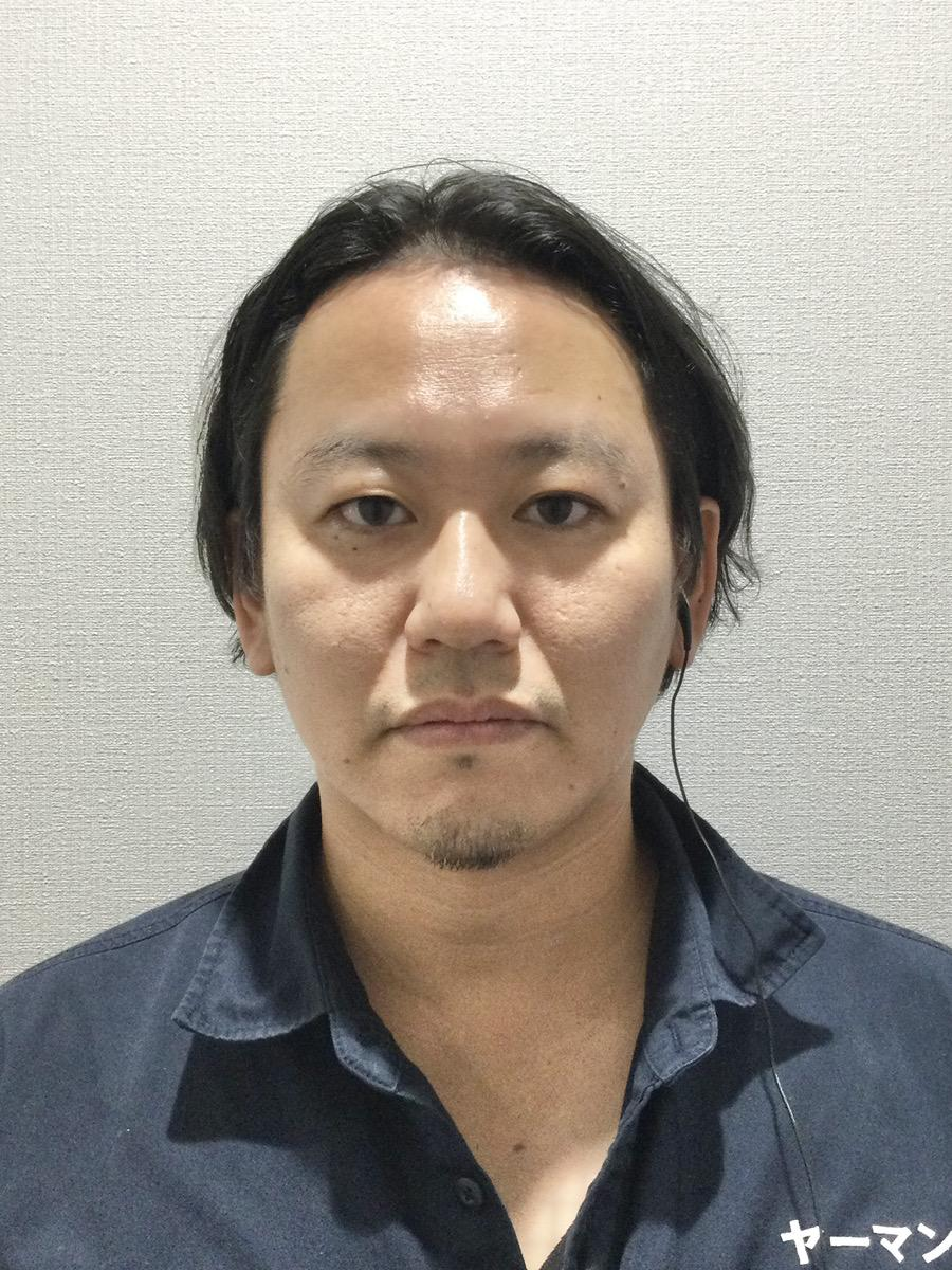 ヒアルロン酸施術前