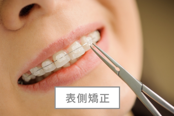 表側矯正