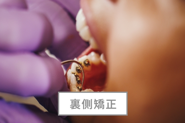 裏側矯正
