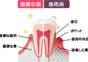 ⻭周病のメカニズム