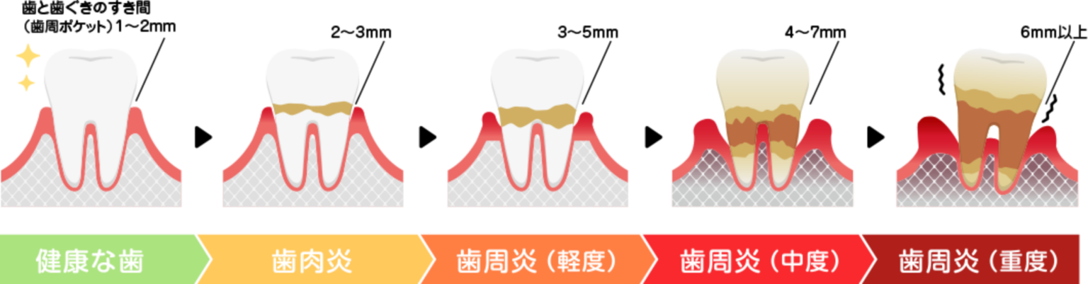 歯周病には段階がある