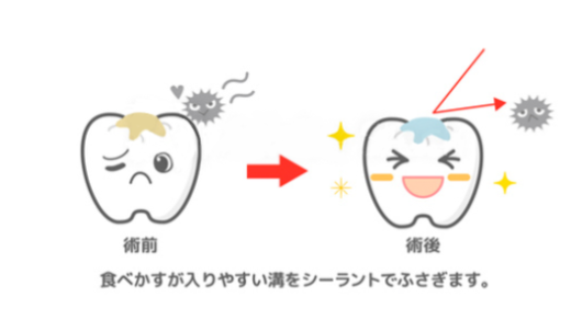 シーラントの実施
